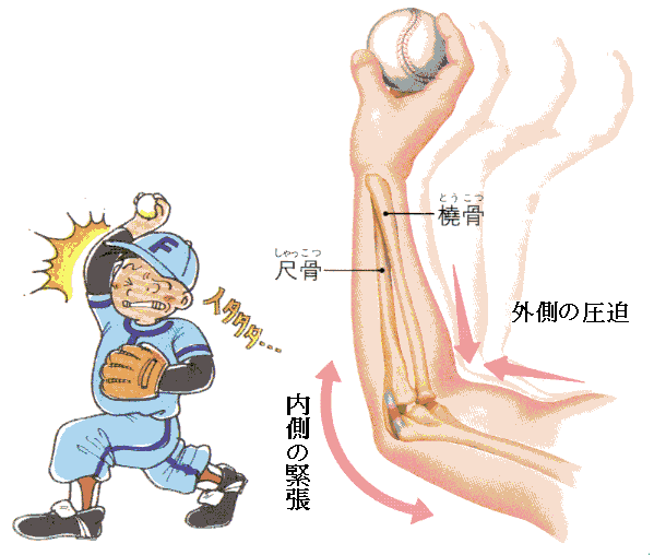「上 腕骨 離 断 性 骨 軟骨 炎」の画像検索結果